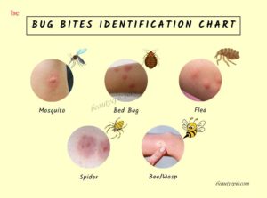 Bug Bites Identification Chart: How to Recognize and Treat Common Insect Bites