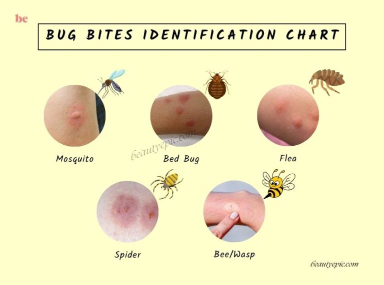 Bug Bites Identification Chart: How to Recognize and Treat Common Insect Bites