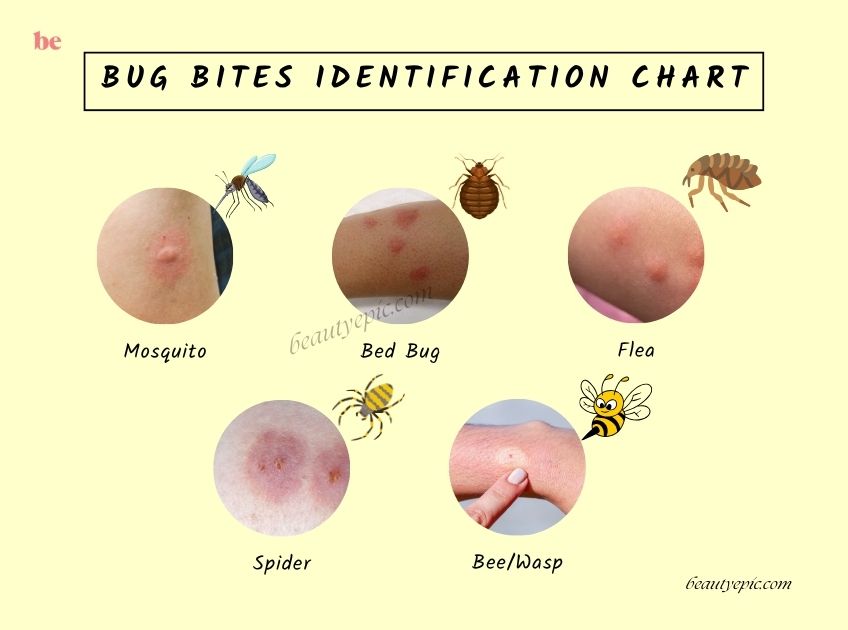 Bug Bites Identification Chart
