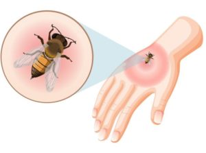 Bee Sting Relief: Safe and Natural Remedies That Work