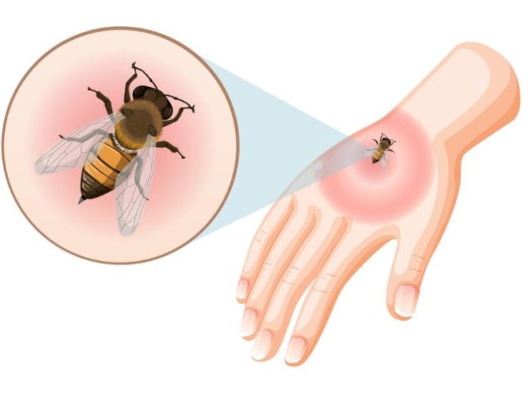 Bee Sting Relief: Safe and Natural Remedies That Work