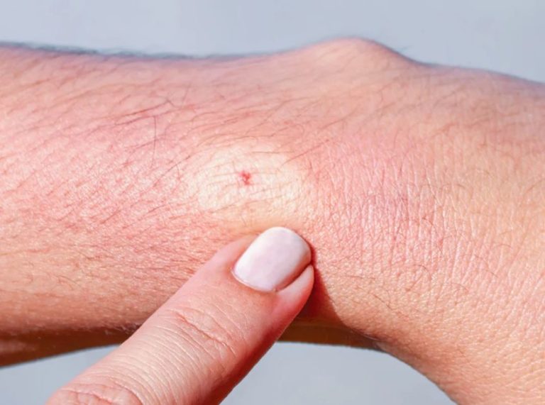 Essential Oils for Bee Stings: What Works and How to Use Them