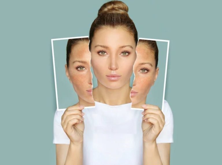 Get Rid Of Uneven Skin Tone: DIY Remedies, Prevention Tips, & More
