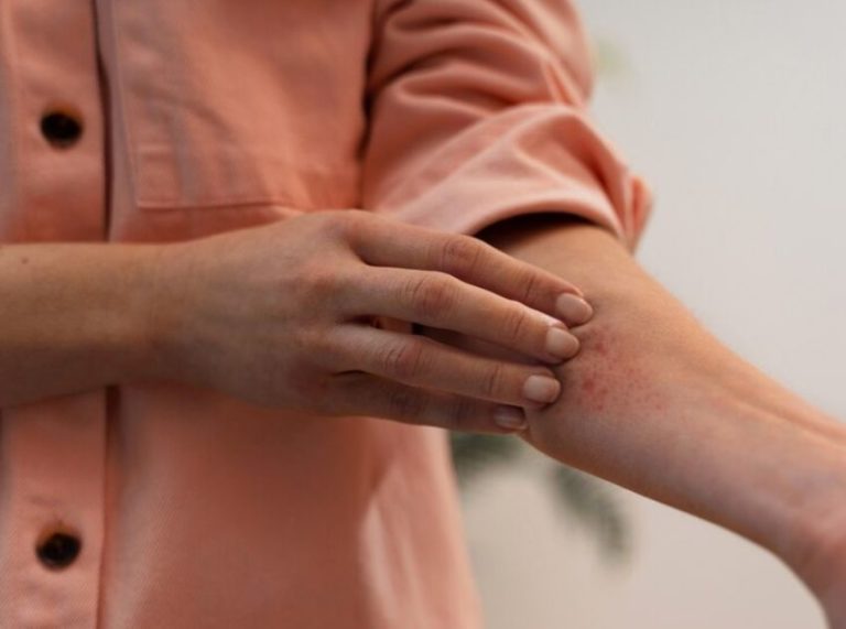 How to Treat a Wasp Sting at Home: Natural Remedies That Work