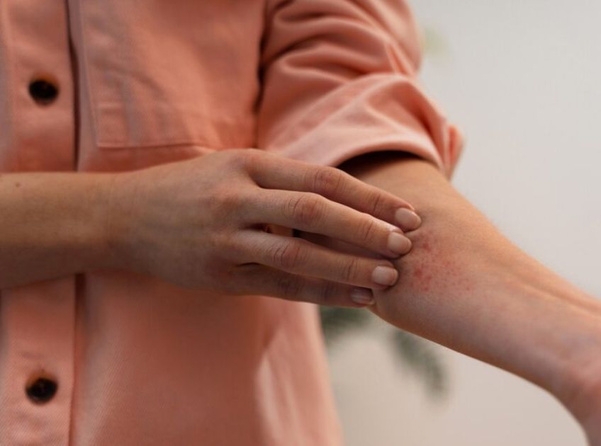 How to Treat a Wasp Sting at Home Natural Remedies That Work