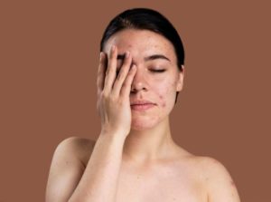 How to Treat Skin Hyperpigmentation Naturally with Simple Remedies