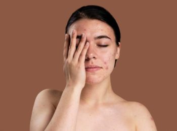How to Treat Skin Hyperpigmentation Naturally with Simple Remedies