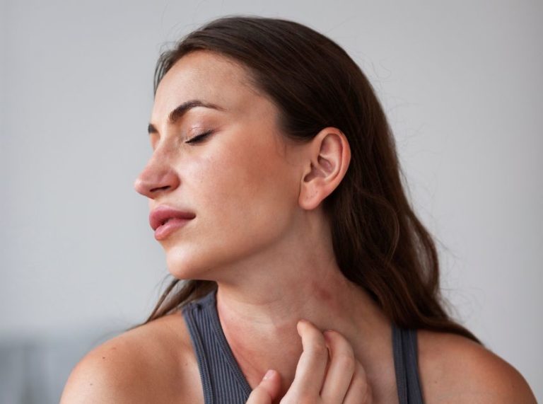 10 Effective Home Remedies for Heat Rash Relief