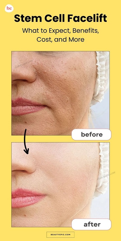 Stem Cell Facelift