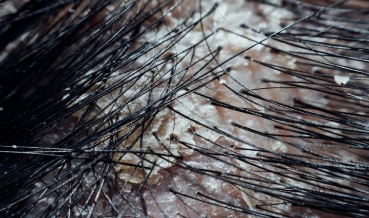What Causes Scalp Buildup