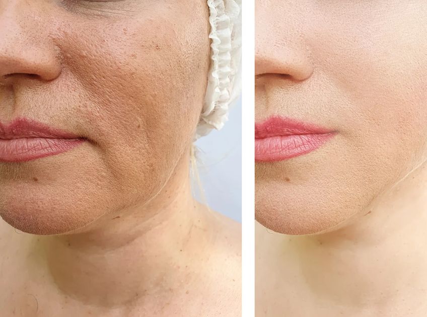 Stem Cell Facelift What to Expect, Benefits, Cost, and More