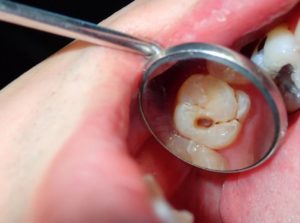 How to Prevent Cavities Naturally: Home Remedies That Work