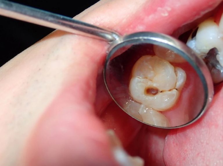 How to Prevent Cavities Naturally: Home Remedies That Work