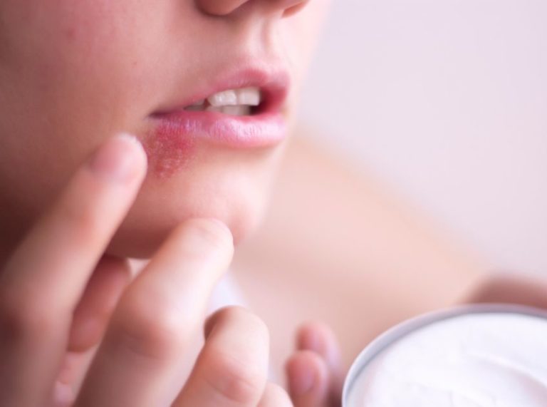 8 Best Home Remedies to Treat a Herpes