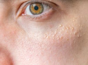7 Safe Home Remedies for Removing Milia
