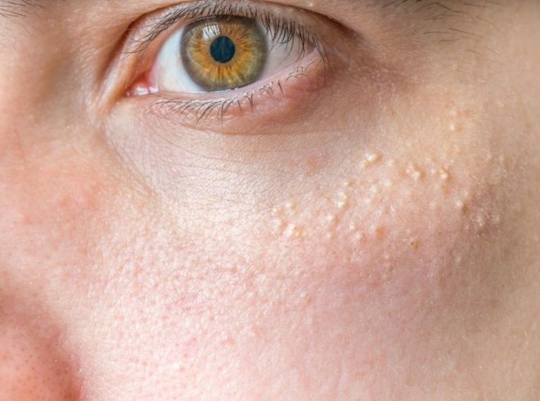 7 Safe Home Remedies for Removing Milia