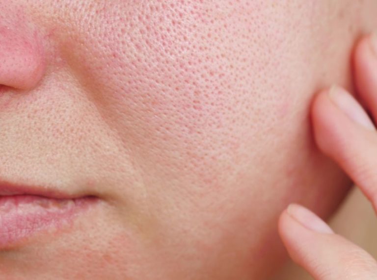 How to Get Rid of Large Pores: Causes, Expert Skincare Tips & Effective Treatments