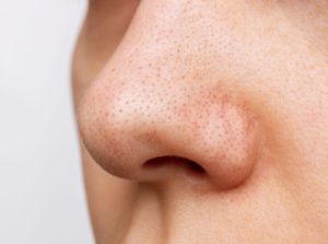 10 DIY Blackhead Remedies That Actually Work