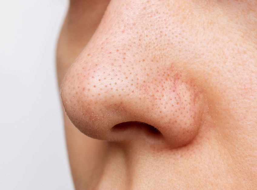10 DIY Blackhead Remedies That Actually Work