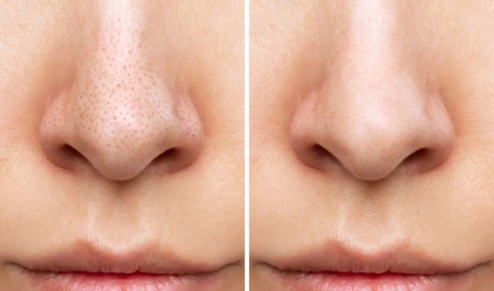 10 DIY Home Remedies to Remove Blackheads