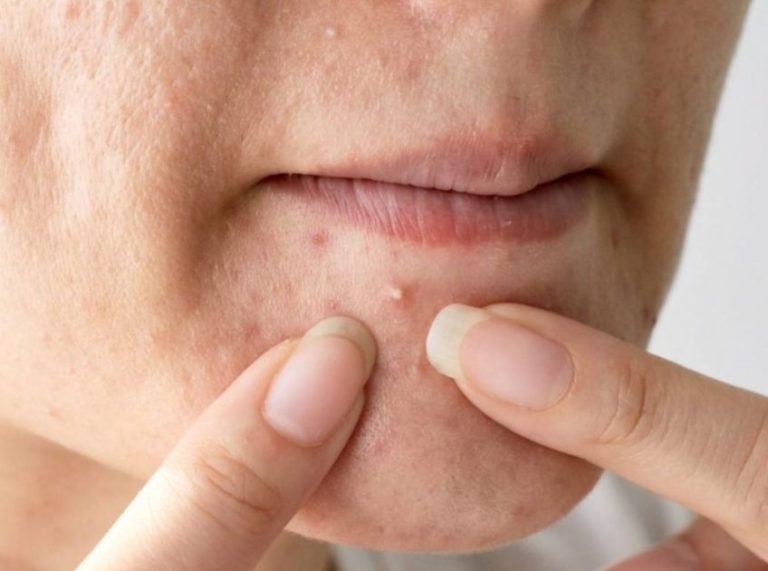 Blind Pimples: What They Are, Causes and How to Get Rid of Them?