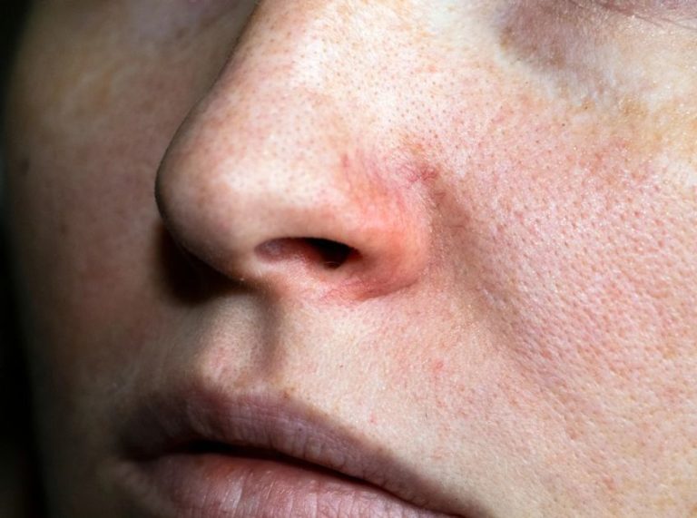 Can Salicylic Acid Help Shrink Open Pores? Here’s What You Need to Know