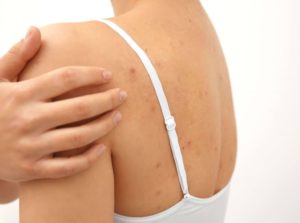 How to Treat Blackheads on Your Back: Causes, Remedies, and Prevention Tips
