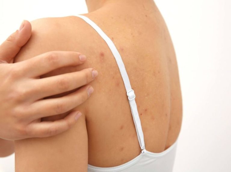 How to Treat Blackheads on Your Back: Causes, Remedies, and Prevention Tips