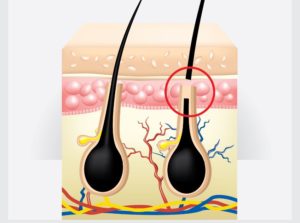 8 DIY Ingrown Hair Removal: Natural Remedies That Actually Work