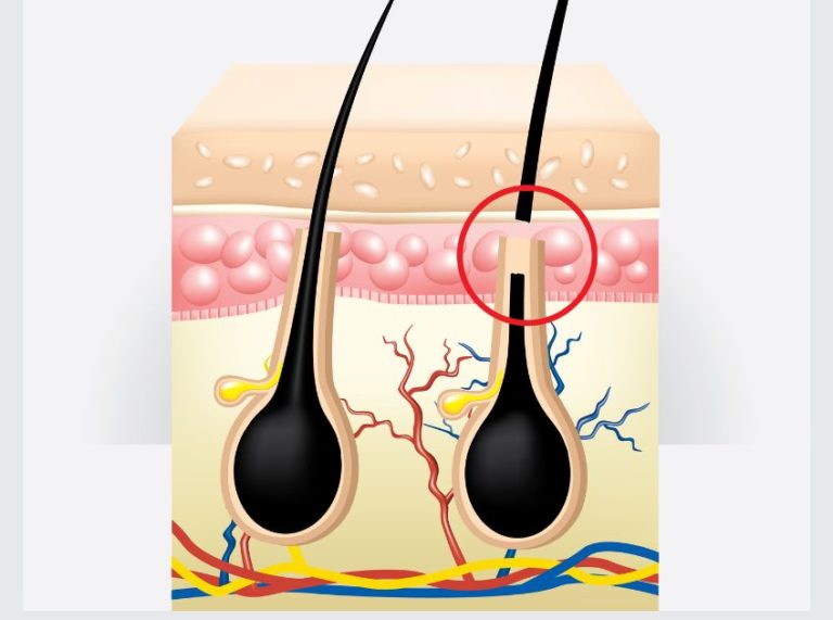 8 DIY Ingrown Hair Removal: Natural Remedies That Actually Work