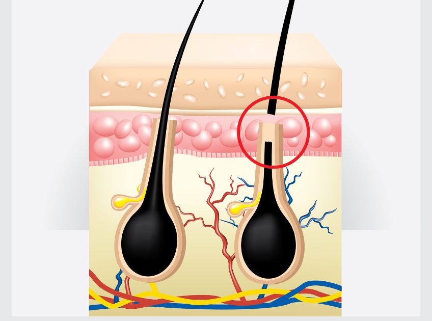 8 DIY Ingrown Hair Removal Natural Remedies That Actually Work