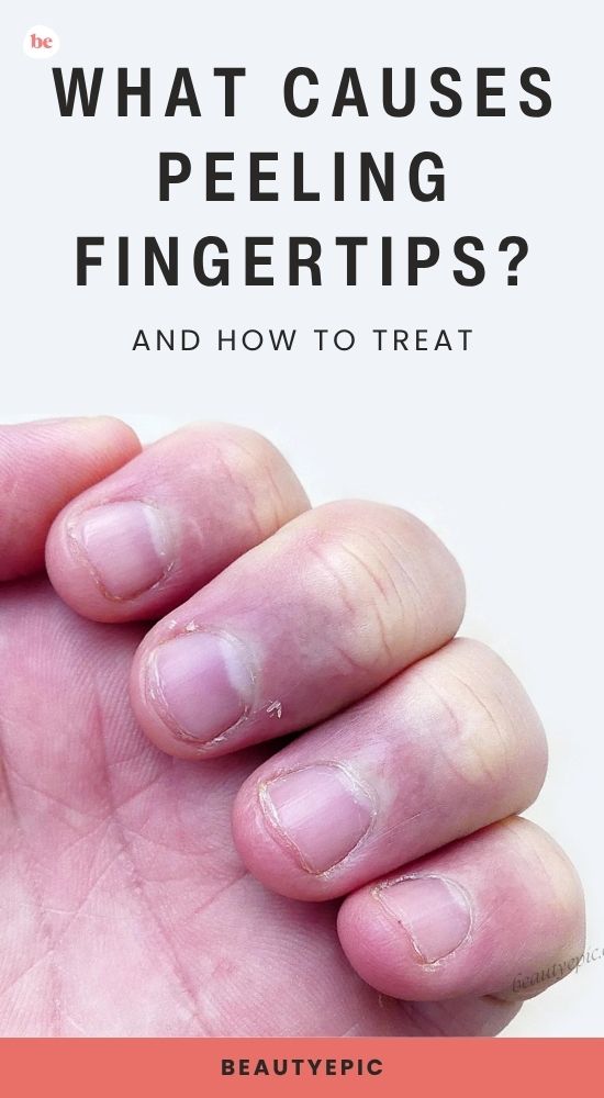 What Causes Peeling Fingertips