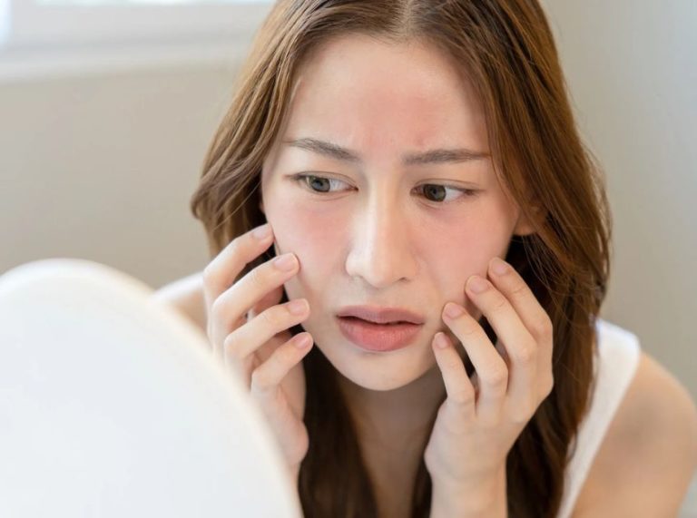 Heat Rash on Face: Causes, Symptoms, Treatments, and Effective Home Remedies