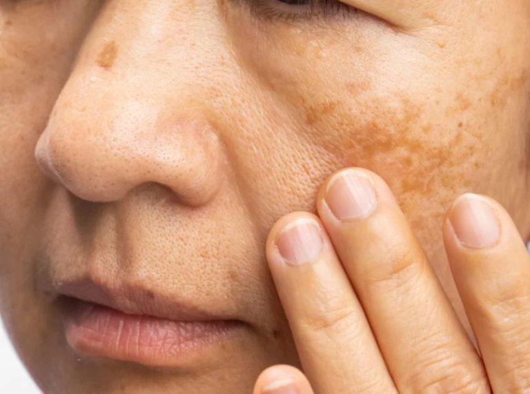 Top Home Remedies for Melasma: Get Clear Skin Naturally