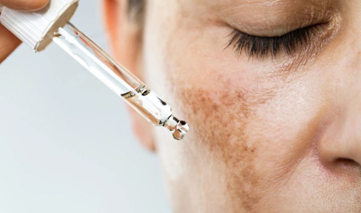 5 Effective Home Remedies for Melasma