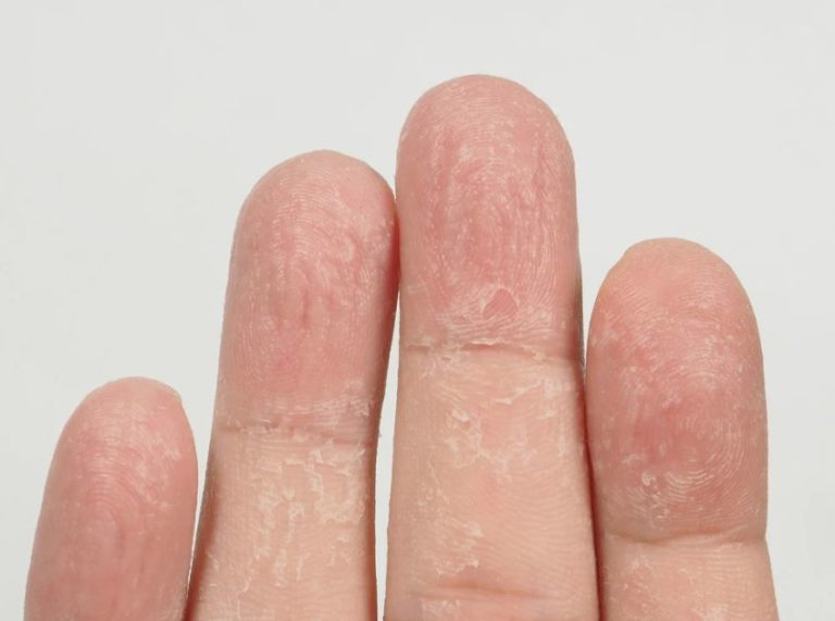 Skin Peeling on Fingertips: Causes, Effective Treatments & Home Remedies That Work