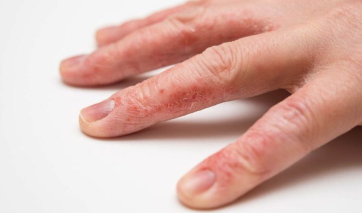 Effective Home Remedies & Treatments for Peeling Fingertips