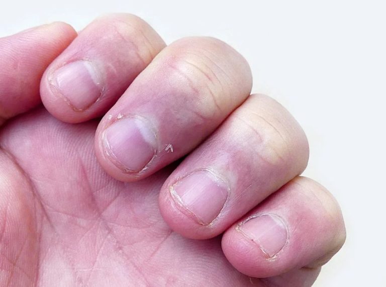 What Causes Peeling Fingertips and How to Treat?