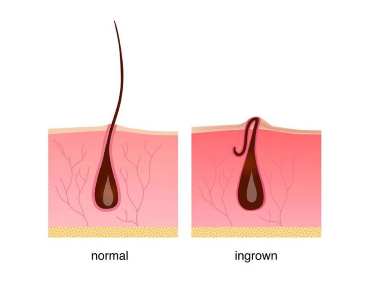 Homemade Ingrown Hair Scrub for Pubic Area: Safe Remedies & Tips
