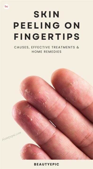Skin Peeling on Fingertips