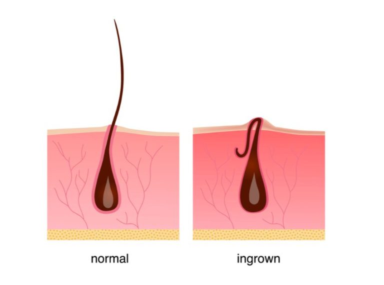 Ingrown Pubic Hair: Causes, Treatment, Prevention, and When to Seek Help