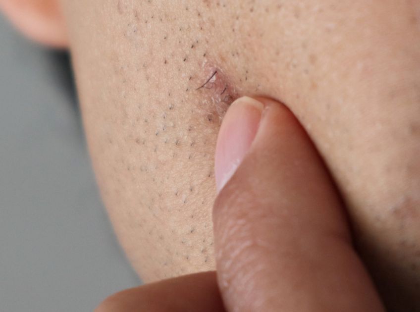 7 Best Home Remedies to Treat and Prevent Ingrown Hairs Naturally