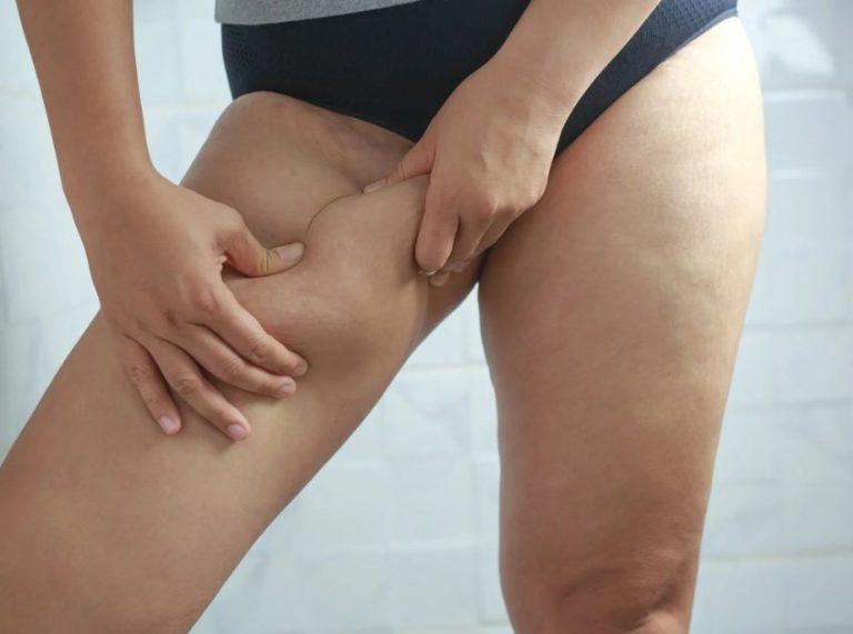 Dark Inner Thighs: Causes, Remedies, and Prevention Tips That Work