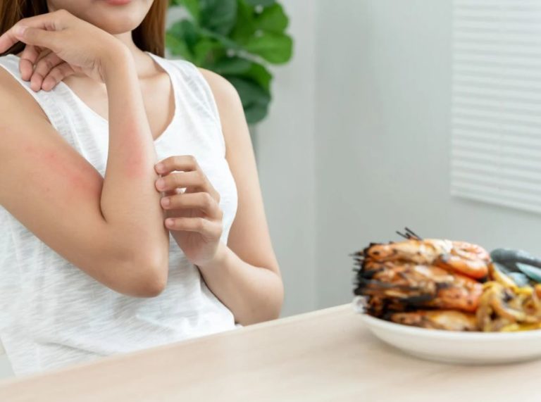 Foods to Avoid with Psoriasis: 7 Triggers That Can Worsen Flare-Ups