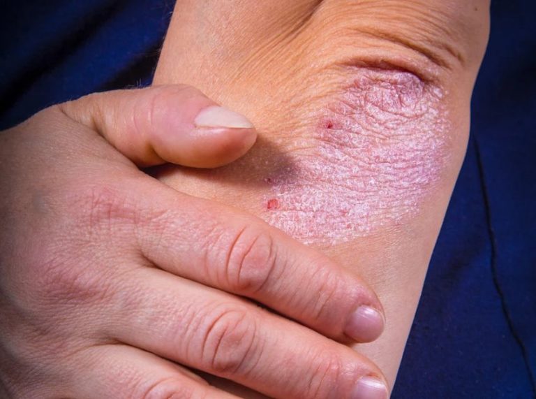 10 Natural Ways to Treat Psoriasis at Home