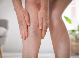 5 Best Essential Oils for Varicose Veins Natural Relief and Care