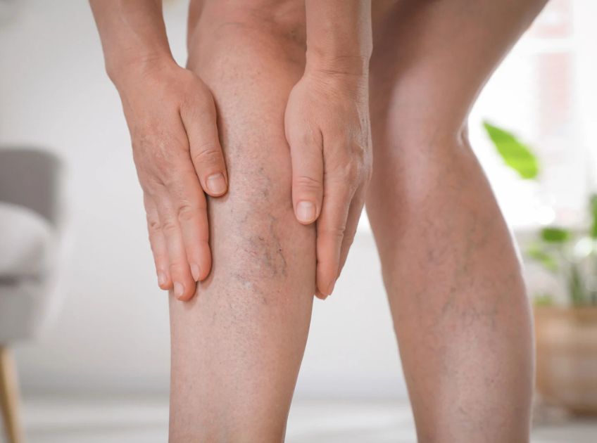 5 Best Essential Oils for Varicose Veins Natural Relief and Care