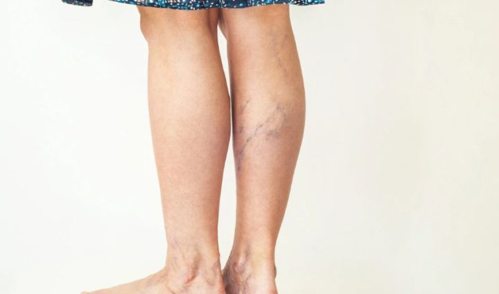 The 5 Best Essential Oils for Varicose Veins