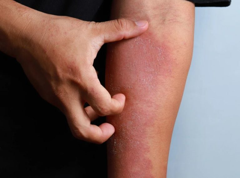 Eczema Diet: The Best and Worst Foods for Managing Flare-Ups