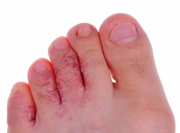 Best Essential Oils for Athlete's Foot